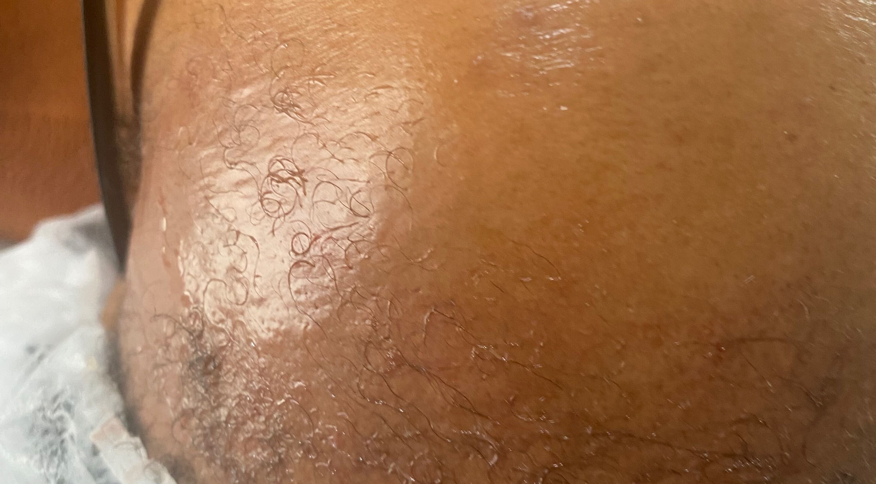 Close-up of a treated area on the face at New You Medical Aesthetics JHB, Sandton, Gauteng, ZA.