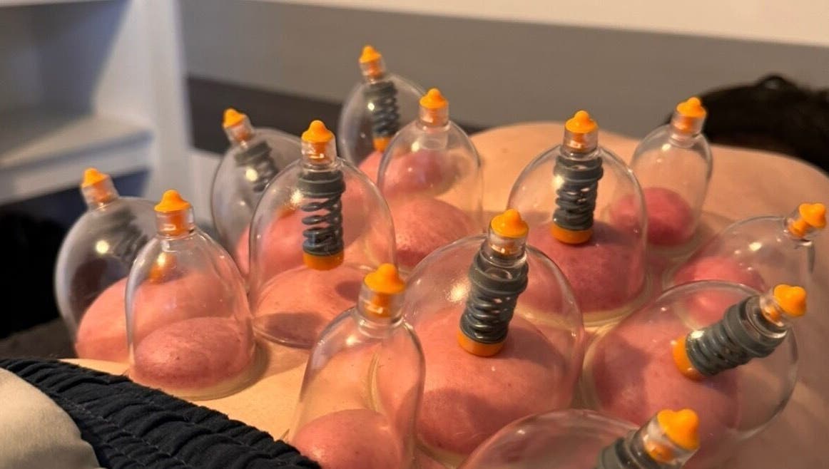 Cupping therapy session at Hzwsportstherapy in Dundee, Scotland, GB offering holistic wellness.