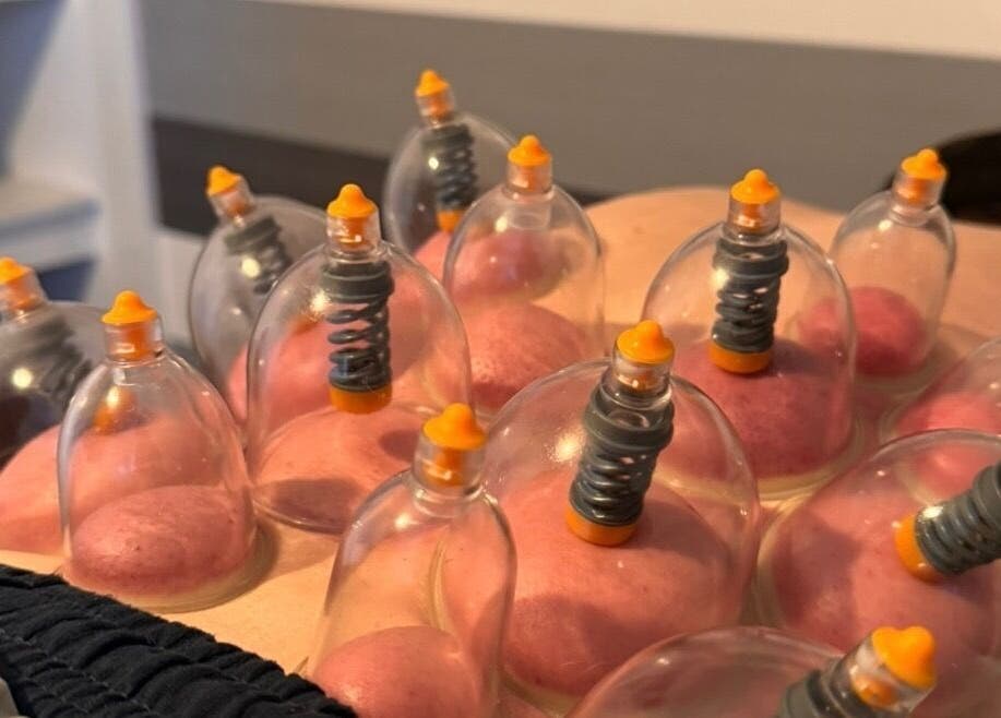 Cupping therapy session at Hzwsportstherapy in Dundee, Scotland, GB offering holistic wellness.