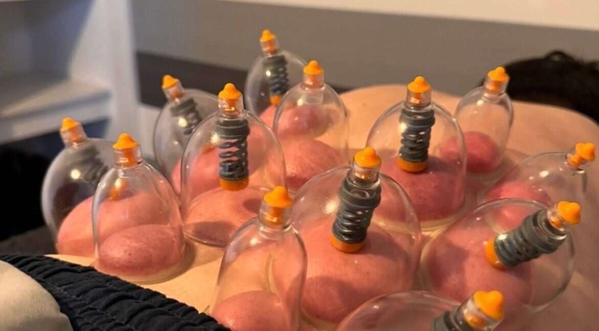 Cupping therapy session at Hzwsportstherapy in Dundee, Scotland, GB offering holistic wellness.