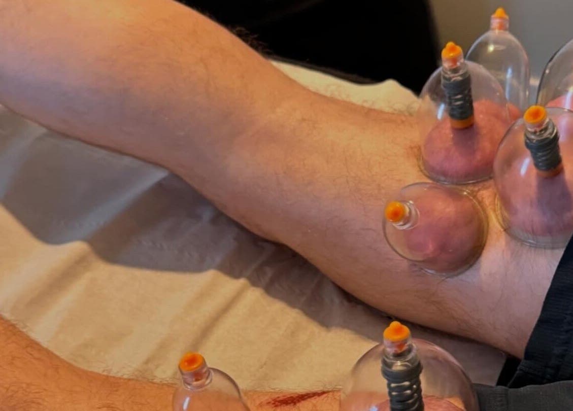 Cupping therapy on legs at Hzwsportstherapy, Dundee, Scotland, GB enhancing muscle recovery.