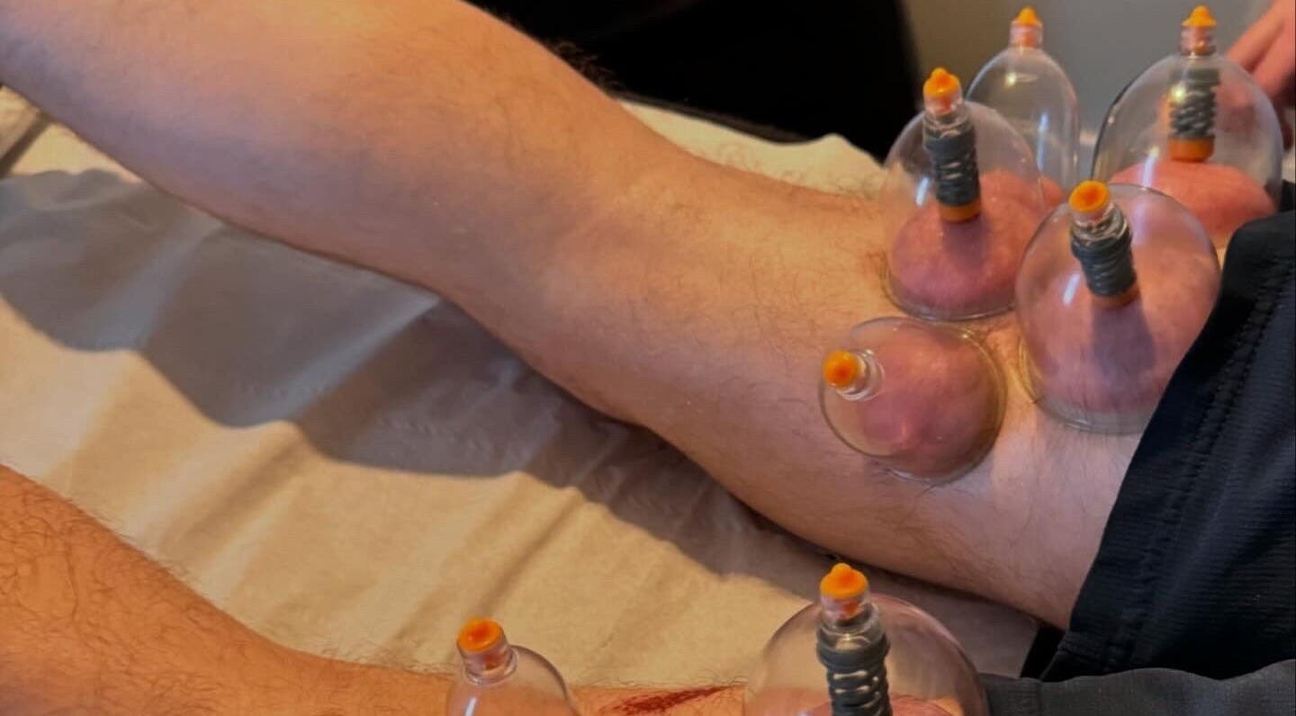 Cupping therapy on legs at Hzwsportstherapy, Dundee, Scotland, GB enhancing muscle recovery.