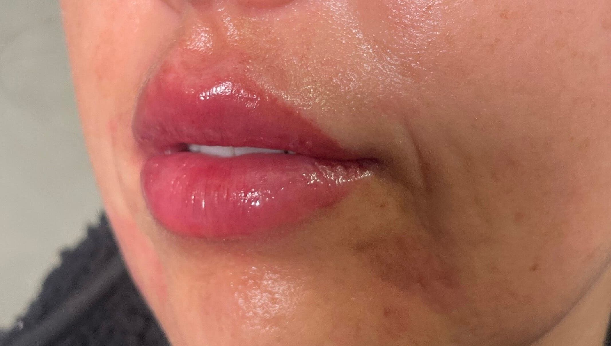 Close-up of enhanced lips treated at Wirral Clinic SATURDAY: Empire Aesthetics, Bebington, Wirral, England, GB.