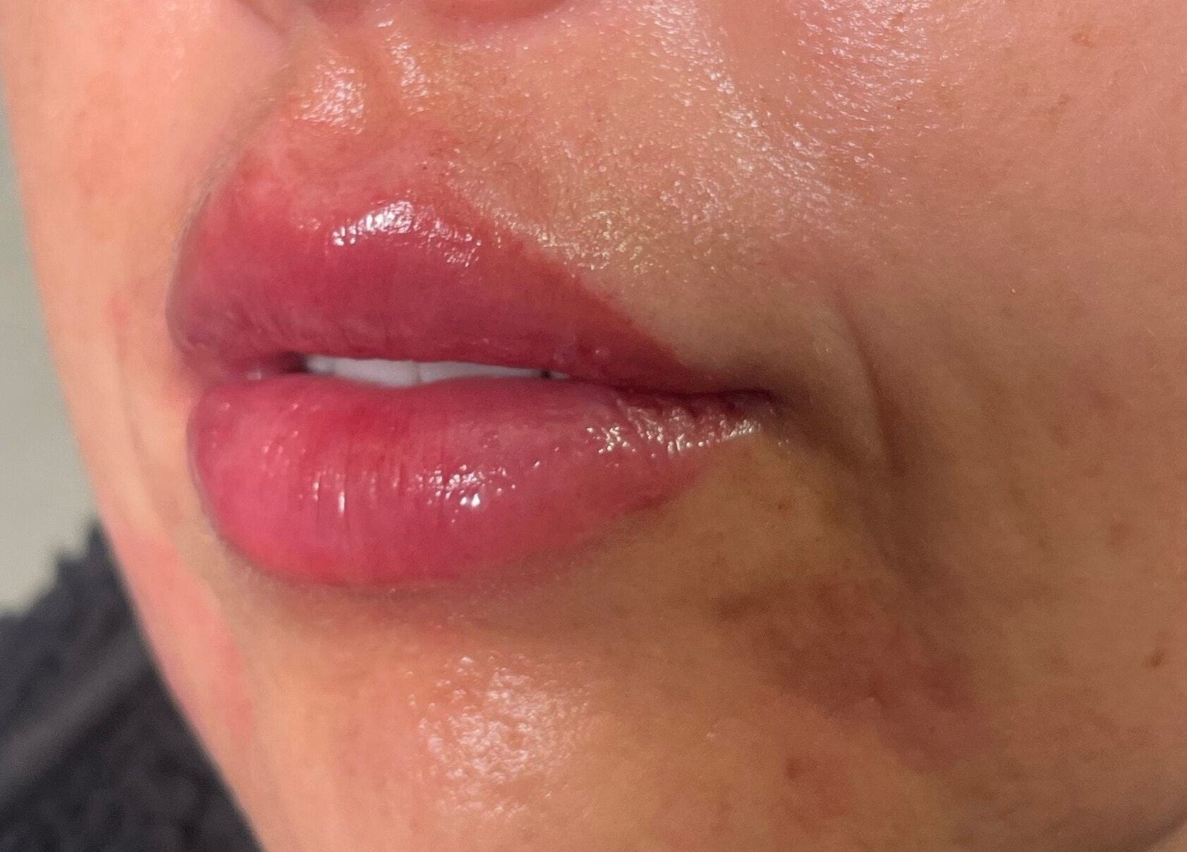 Close-up of enhanced lips treated at Wirral Clinic SATURDAY: Empire Aesthetics, Bebington, Wirral, England, GB.