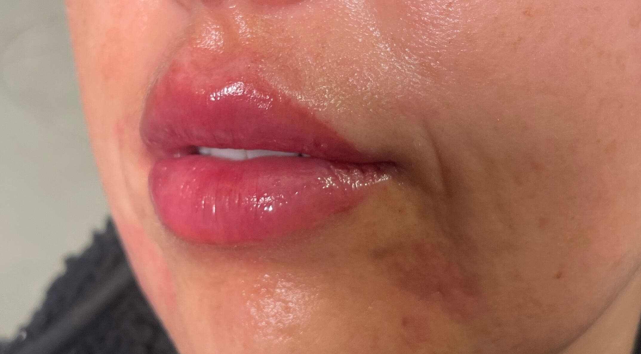 Close-up of enhanced lips treated at Wirral Clinic SATURDAY: Empire Aesthetics, Bebington, Wirral, England, GB.