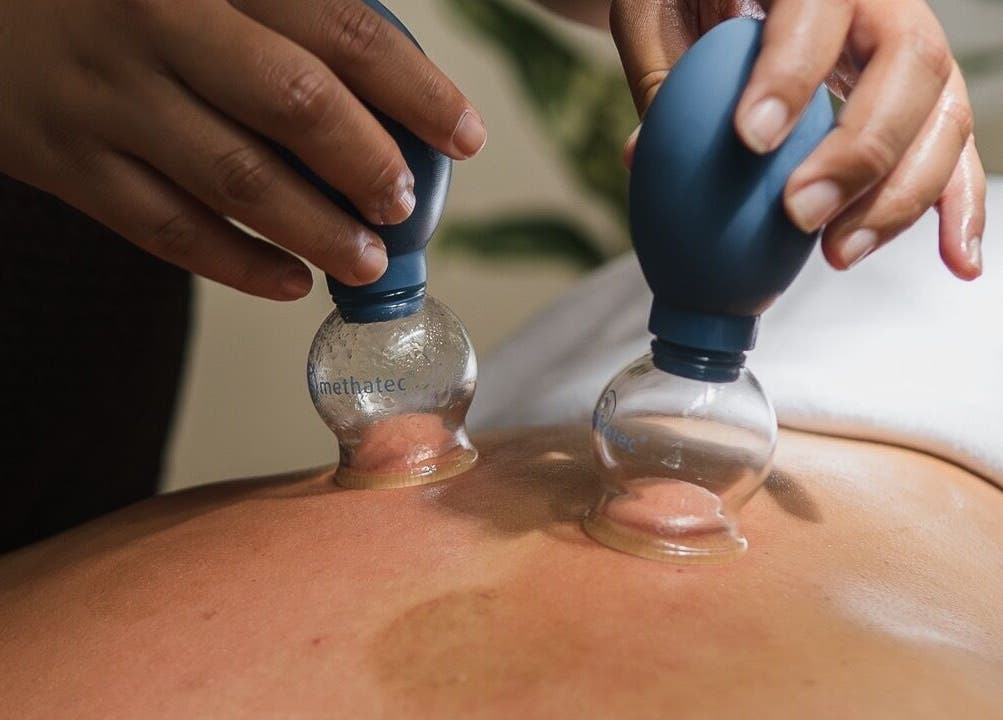 Cupping therapy at Cupping It Out in Oranjestad, AW, showing hands applying suction cups on a back.