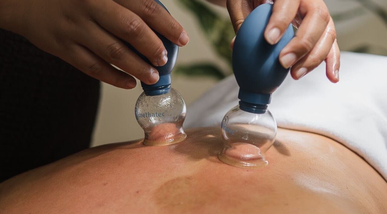 Cupping therapy at Cupping It Out in Oranjestad, AW, showing hands applying suction cups on a back.