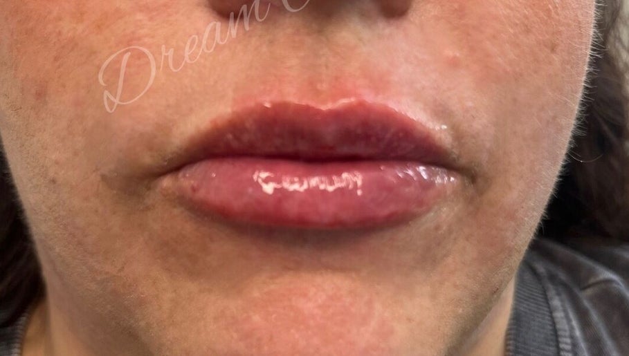 Close-up of glossy lips after treatment at Dream Aesthetics, Chelmsford, England, GB.