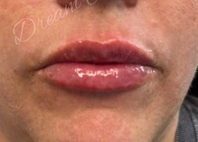 Close-up of glossy lips after treatment at Dream Aesthetics, Chelmsford, England, GB.