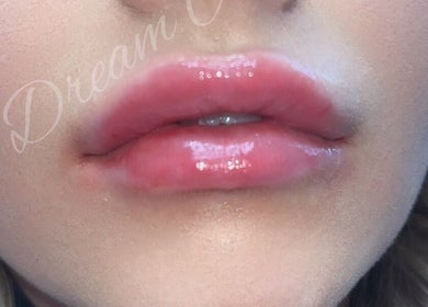 Close-up of glossy lips from Dream Aesthetics, Chelmsford, England, GB showcasing lip enhancement service.