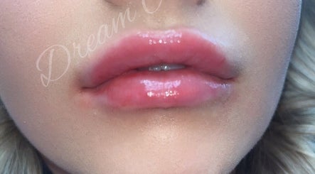 Close-up of glossy lips from Dream Aesthetics, Chelmsford, England, GB showcasing lip enhancement service.