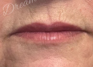 Close-up of lips showcasing anti-aging treatment at Dream Aesthetics, Chelmsford, England, GB.