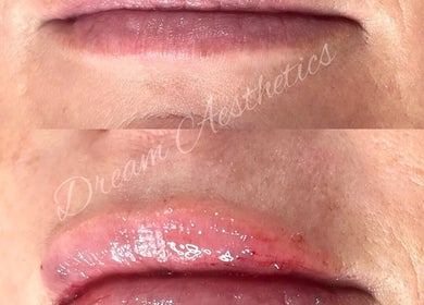 Stunning lip enhancement before and after at Dream Aesthetics, Chelmsford, England, GB.