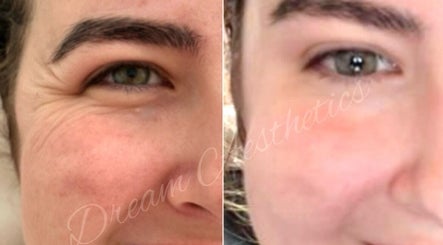 Before and after facial treatment at Dream Aesthetics, Chelmsford, England, GB showcasing eye wrinkle reduction.