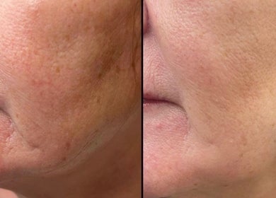 Before and after skin treatment at Head Turner, Shrewsbury, England, GB showcasing improved skin texture.