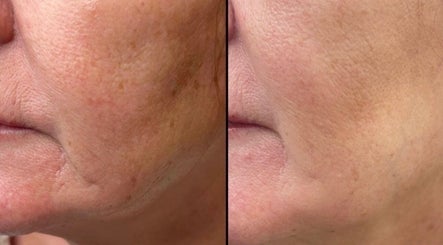 Before and after skin treatment at Head Turner, Shrewsbury, England, GB showcasing improved skin texture.