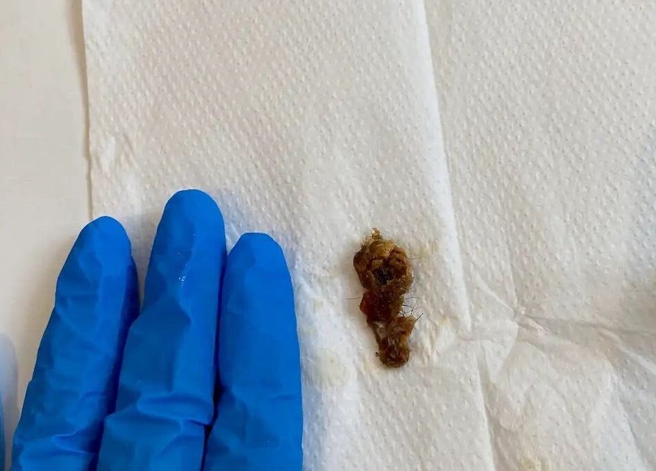 Ear cleaning at Crystal Clear Hearing, Burton Upon Trent, England, GB. Gloved hands, earwax on tissue.