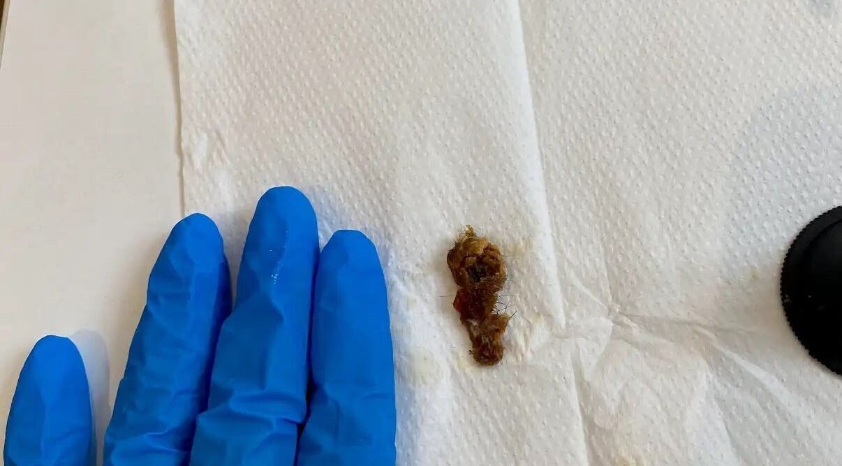 Ear cleaning at Crystal Clear Hearing, Burton Upon Trent, England, GB. Gloved hands, earwax on tissue.