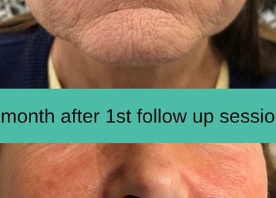Close-up of skin transformation one month after treatment at AKBrows Accrington, Accrington, England, GB.