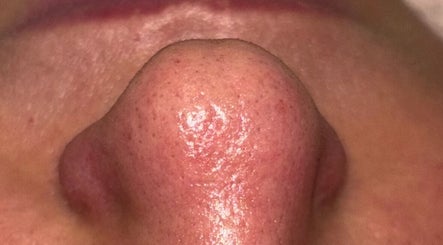 Hydra facial image 2