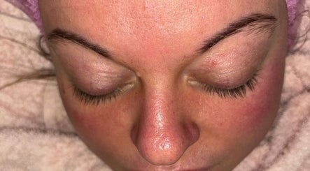 Hydra facial image 3