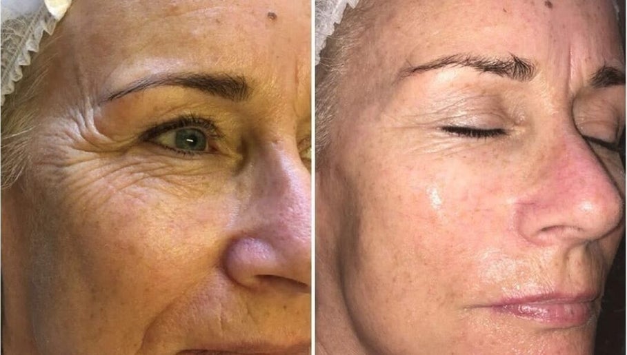 Before and after facial treatment at Pretty Perfect at Dolce Capelli, Glasgow, Scotland, GB. Visible skin improvement.