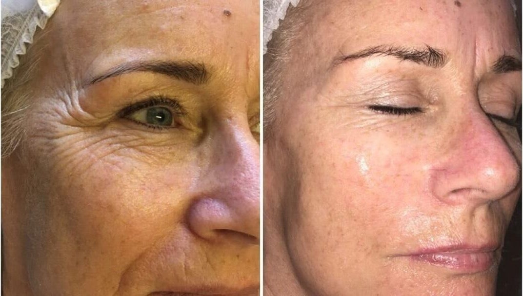 Before and after facial treatment at Pretty Perfect at Dolce Capelli, Glasgow, Scotland, GB. Visible skin improvement.