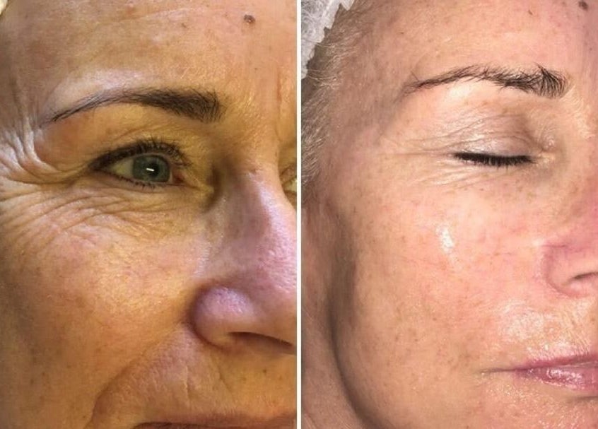 Before and after facial treatment at Pretty Perfect at Dolce Capelli, Glasgow, Scotland, GB. Visible skin improvement.