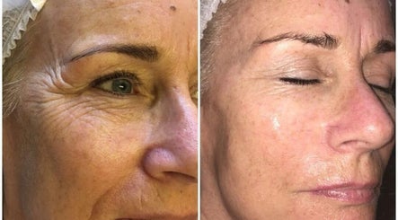 Before and after facial treatment at Pretty Perfect at Dolce Capelli, Glasgow, Scotland, GB. Visible skin improvement.