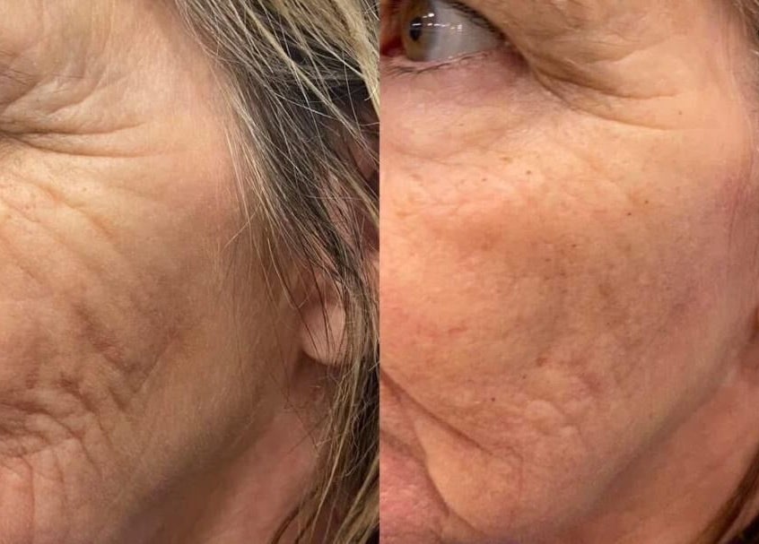 Before and after skin treatment at Pretty Perfect at Dolce Capelli, Glasgow, Scotland, GB, showing reduced wrinkles.