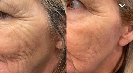 Before and after skin treatment at Pretty Perfect at Dolce Capelli, Glasgow, Scotland, GB, showing reduced wrinkles.