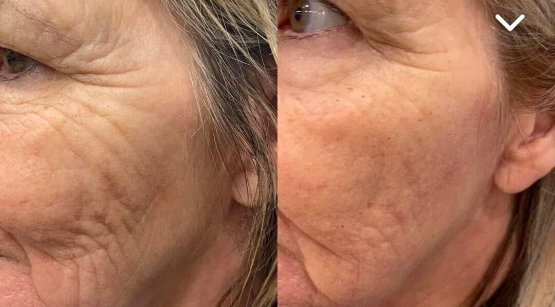 Before and after skin treatment at Pretty Perfect at Dolce Capelli, Glasgow, Scotland, GB, showing reduced wrinkles.