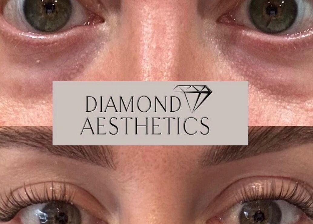 Before and after eye enhancement at Diamond Aesthetics, Reading, England, GB.
