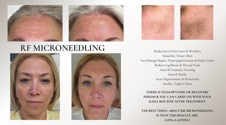 RF microneedling treatment results at Skinergi, Corby, England, GB, showcasing smoother skin and reduced wrinkles.