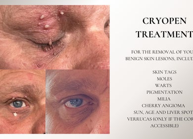 Close-up of skin lesion treatment at Skinergi in Corby, England, GB using Cryopen for skin tag removal.