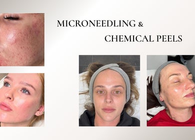 Facial rejuvenation results from microneedling and chemical peels at Skinergi, Corby, England, GB.