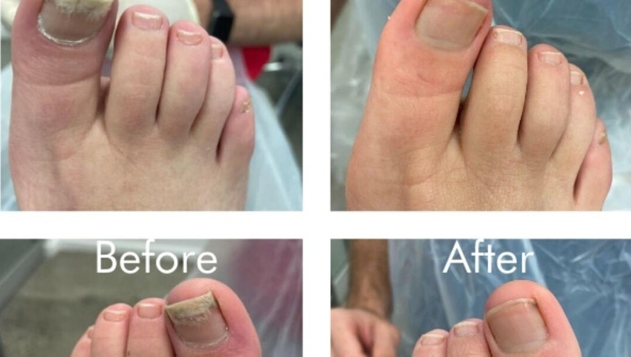Before and after toenail care at Skin Medics@Bombshell, Basingstoke, England, GB.