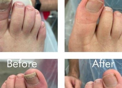 Before and after toenail care at Skin Medics@Bombshell, Basingstoke, England, GB.