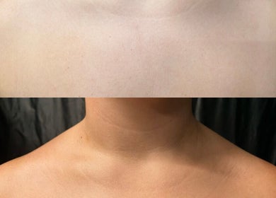 Before and after neck treatment at X&O Beauty Co in Melbourne, Victoria, AU showcasing skin improvement.