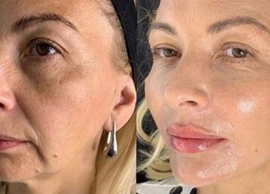 Before and after facial treatment at Elevè Aesthetics & Beauty in Radcliffe, England, GB highlighting skin rejuvenation.