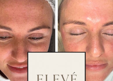Before and after facial treatment at Elevè Aesthetics & Beauty, Radcliffe, England, GB, showcasing glowing skin results.
