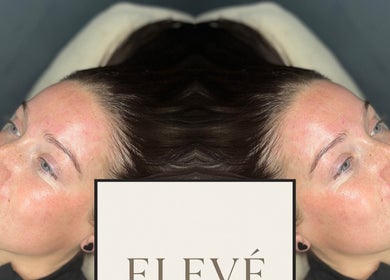 Client with radiant skin at Elevè Aesthetics & Beauty in Radcliffe, England, GB, post-treatment glow.