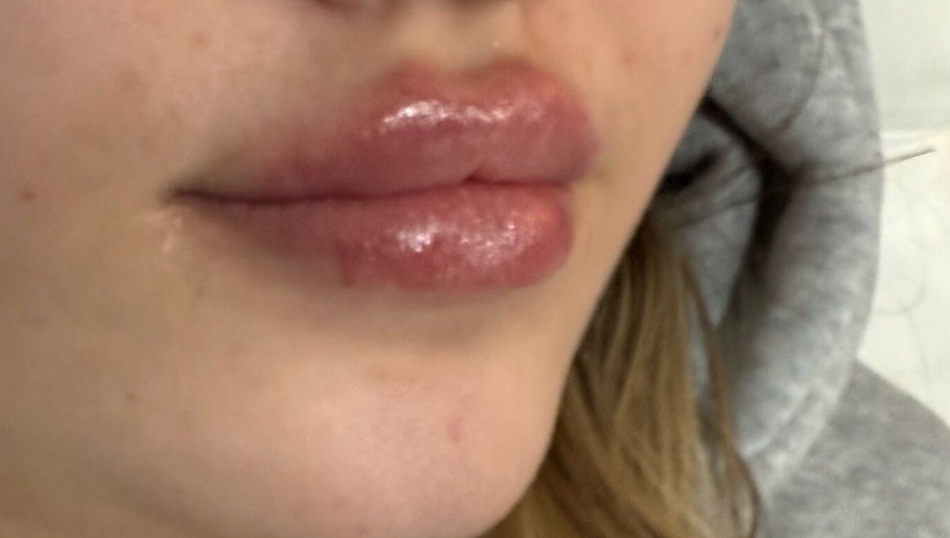 Close-up of glossy, plump lips treated at Elevè Aesthetics & Beauty, Radcliffe, England, GB.