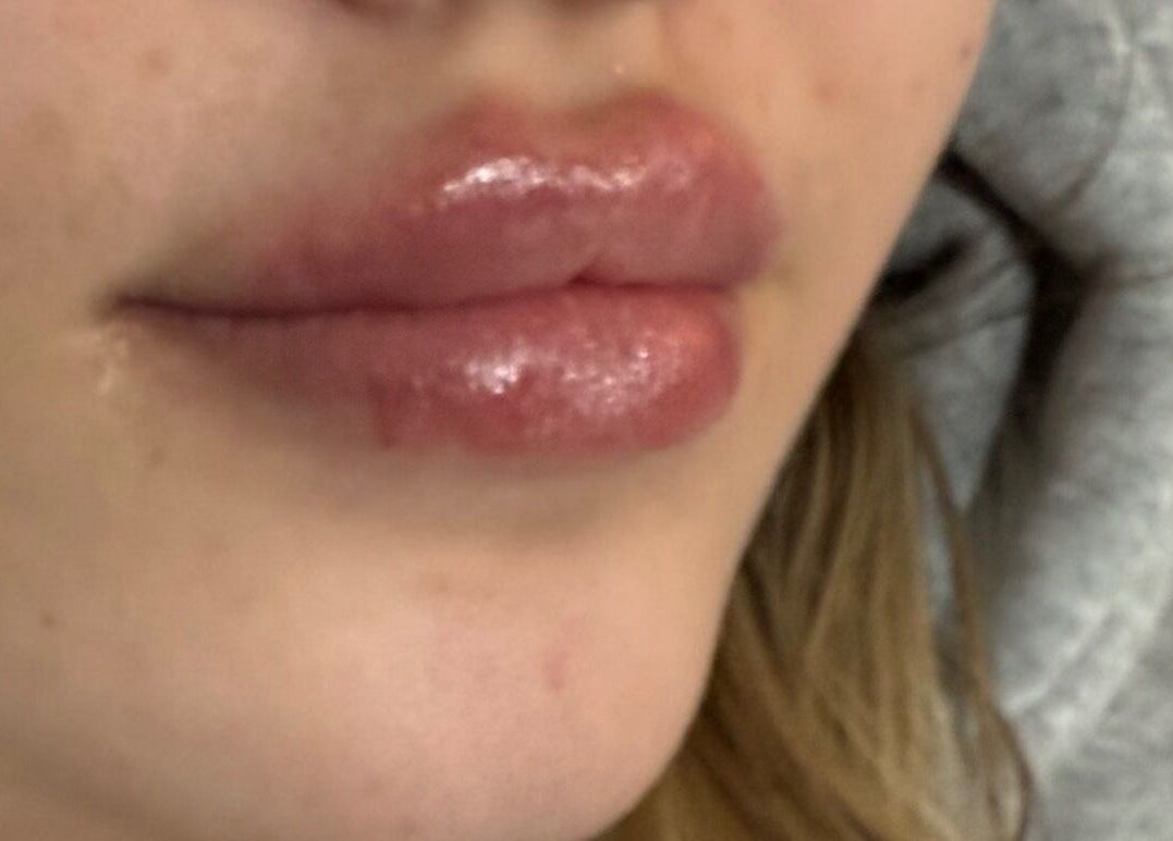Close-up of glossy, plump lips treated at Elevè Aesthetics & Beauty, Radcliffe, England, GB.