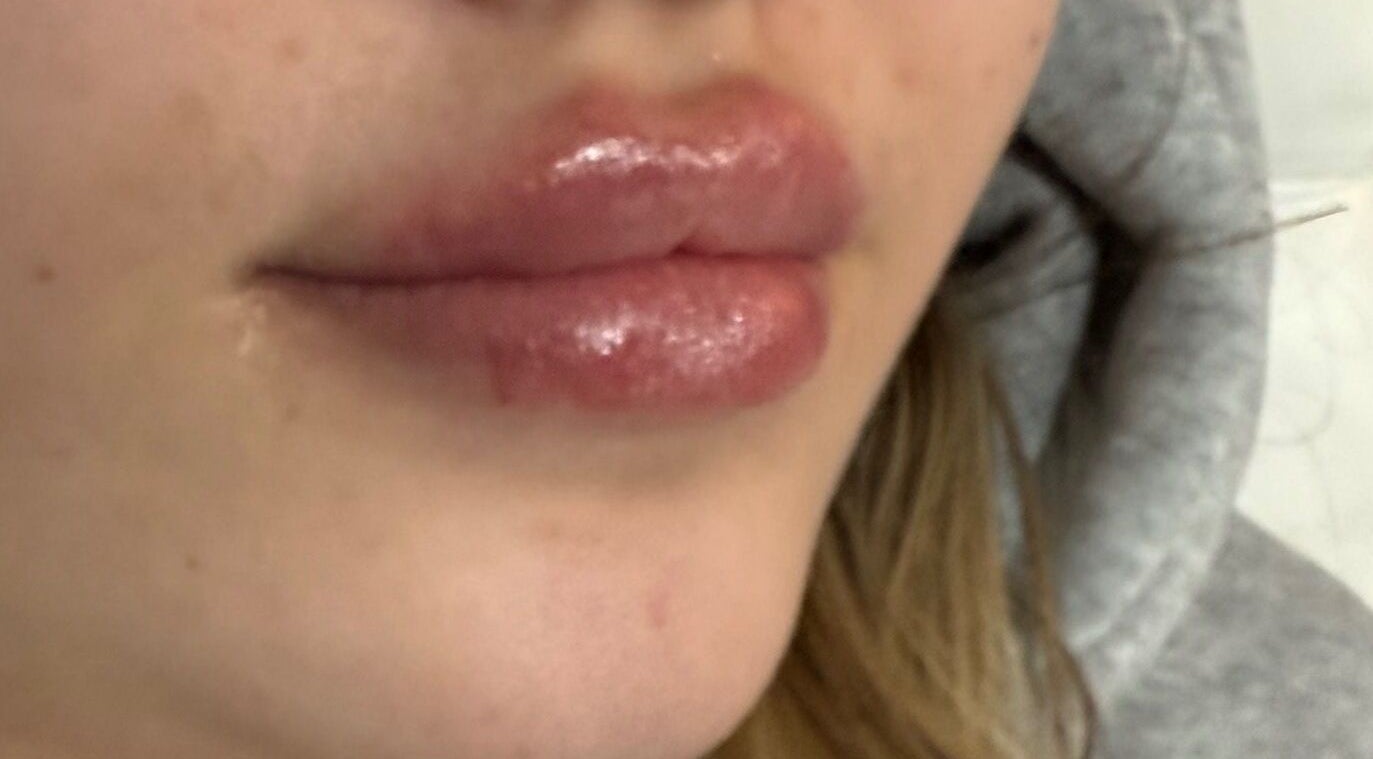 Close-up of glossy, plump lips treated at Elevè Aesthetics & Beauty, Radcliffe, England, GB.