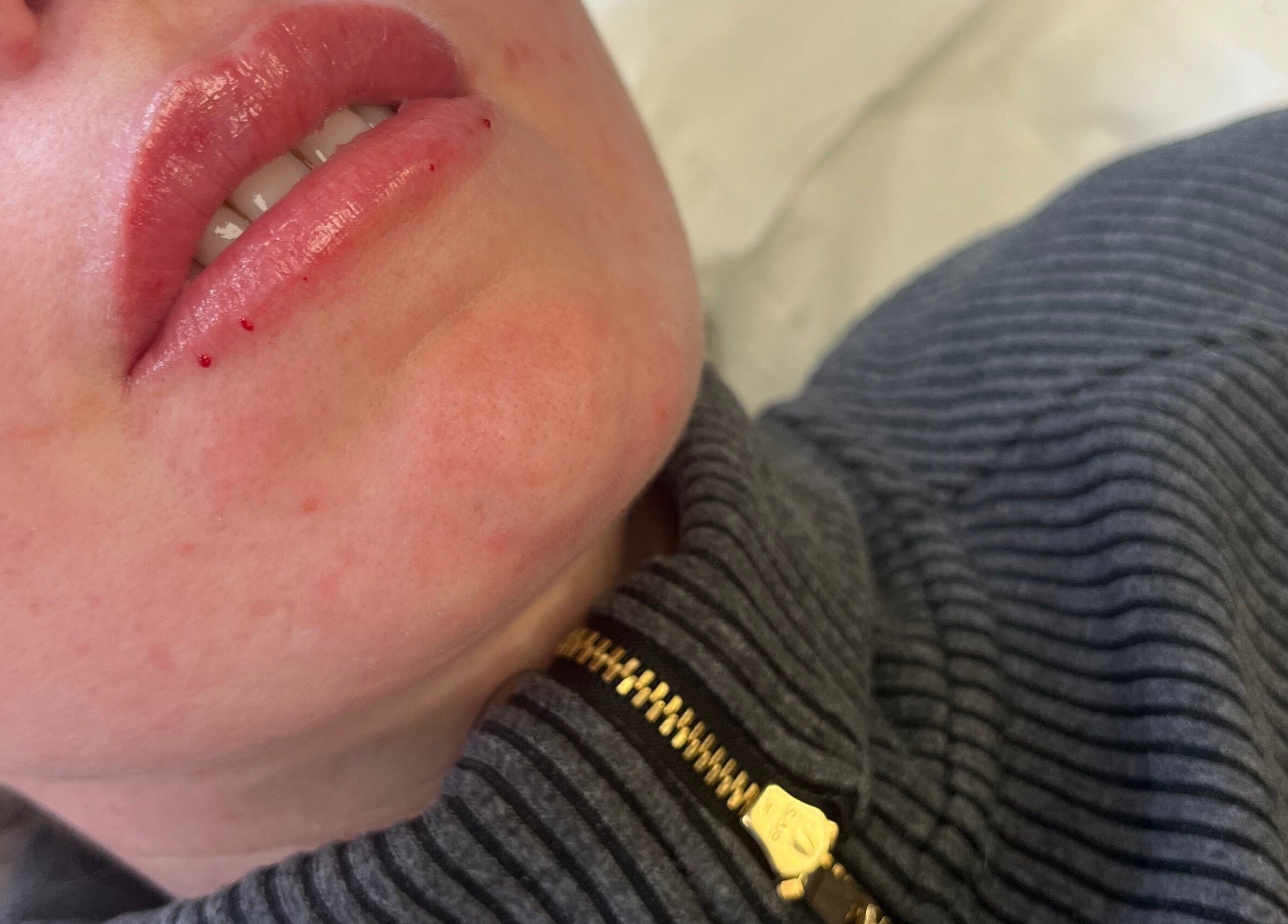 Lip treatment at Elevè Aesthetics & Beauty in Radcliffe, England, GB, highlighting glowing skin results.