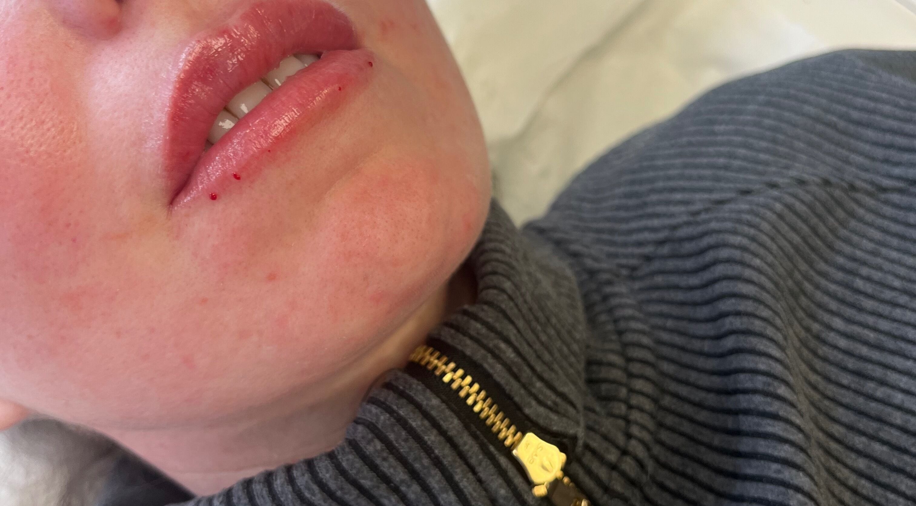 Lip treatment at Elevè Aesthetics & Beauty in Radcliffe, England, GB, highlighting glowing skin results.