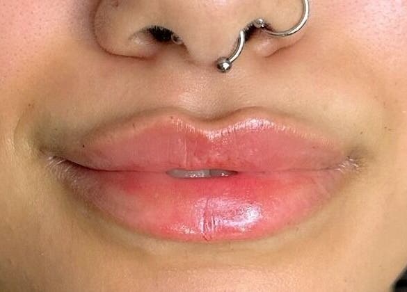 Close-up of enhanced lips at Aspinall Aesthetics, Kingswood, England, GB, showcasing lip artistry.