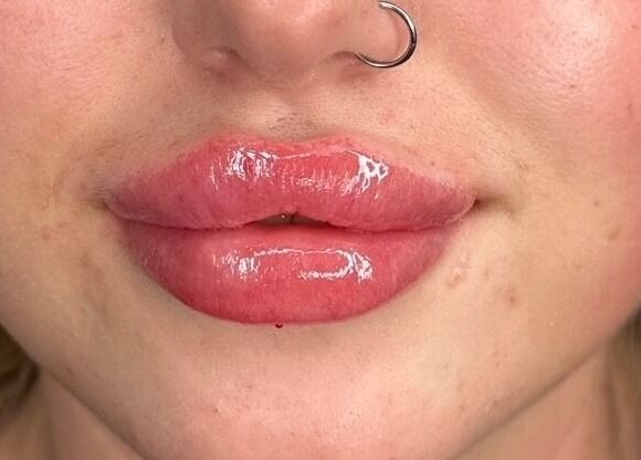 Close-up of glossy lips after treatment at Aspinall Aesthetics, Kingswood, England, GB.