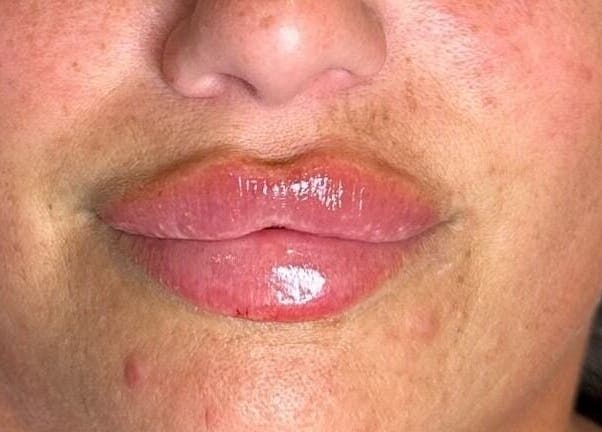 Close-up of luscious lips after treatment at Aspinall Aesthetics in Kingswood, England, GB.